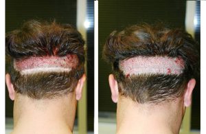 کاشت مو بدون جراحی