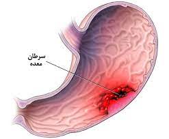 درمان گیاهی سرطان معده