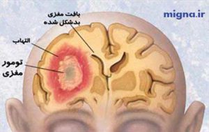 درمان تومور مغزی با گیاهان دارویی