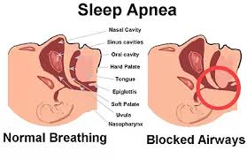 علائم تنگی نفس در خواب