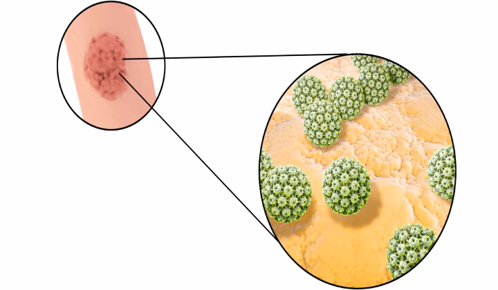 اچ پی وی چیست؟؟